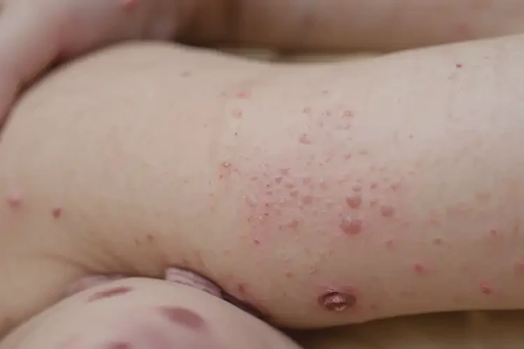 少兒四肢起濕疹能夠徹底治愈嗎(圖4)