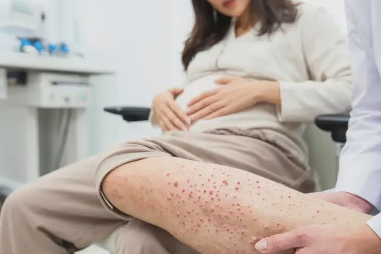 孕妇小腿上容易起湿疹可不可以彻底自愈(图4)