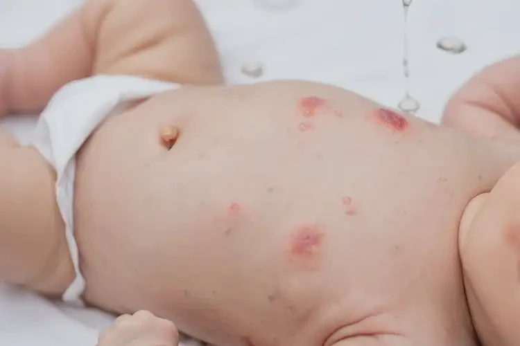 新生儿肚子上经常起湿疹不管它会自己痊愈吗(图4)