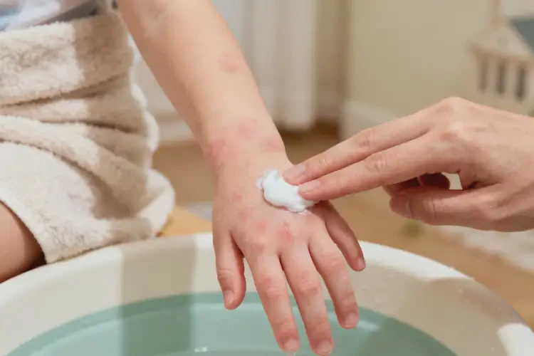 孩子手上偶爾長(zhǎng)濕疹能靠自己自愈嗎(圖4)