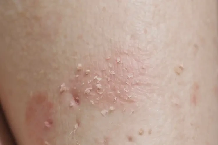 女生大腿上容易長濕疹不管它會自己痊愈嗎(圖4)