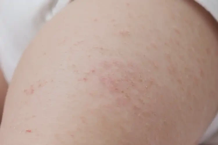 幼兒大腿上偶爾起濕疹能靠自己自愈嗎(圖4)