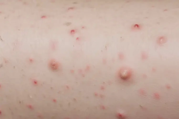 小孩小腿出現(xiàn)濕疹能徹底自愈嗎(圖4)