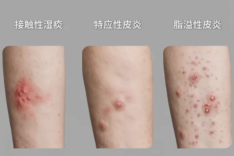男人大腿上出濕疹不管它會自己好嗎(圖2)