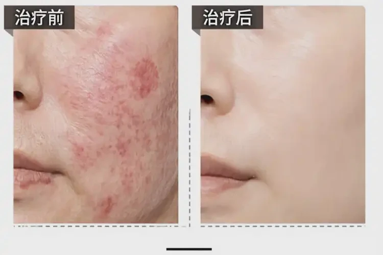 女性肛周容易長濕疹不管它會(huì)自己好嗎(圖2)