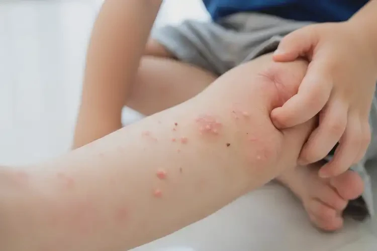 孩子小腿偶爾長濕疹不管它會自己痊愈嗎(圖4)