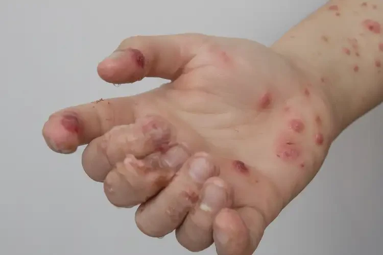 青少年手上出現(xiàn)濕疹能靠自己自愈嗎(圖4)