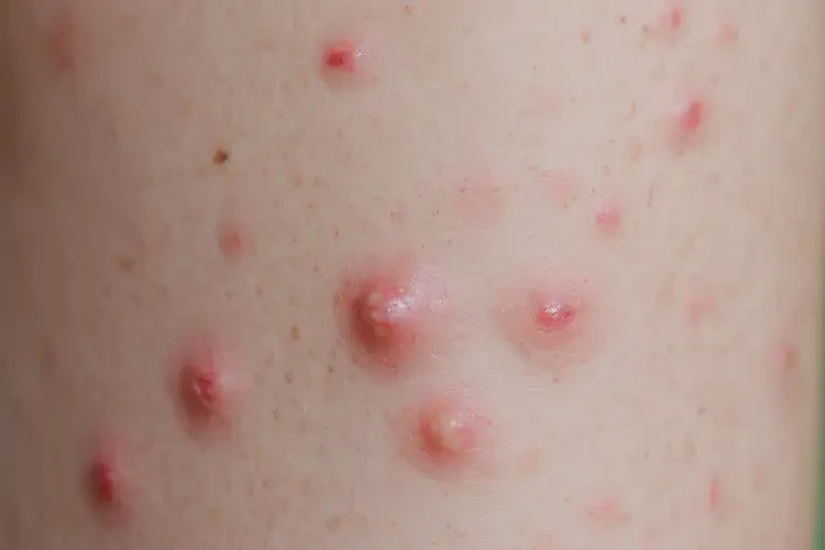 小學(xué)生小腿經(jīng)常長濕疹可不可以徹底自愈(圖4)