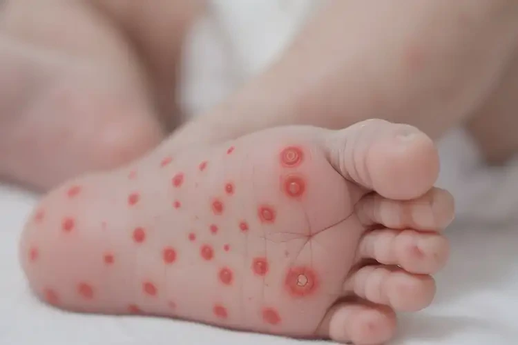 新生兒小腿偶爾長濕疹能徹底自愈嗎(圖2)