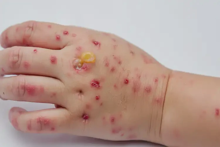 孩子手上經(jīng)常長濕疹能靠自己自愈嗎(圖3)
