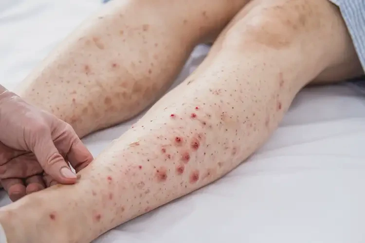 產(chǎn)婦小腿起濕疹不管它會(huì)自己自愈嗎(圖4)