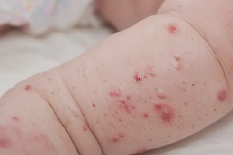 婴幼儿小腿经常起湿疹不管它会自己痊愈吗(图4)