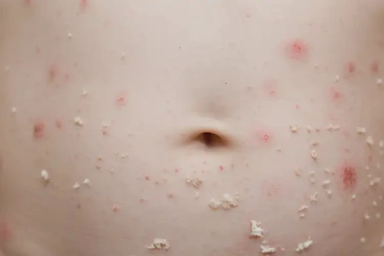 少兒肚子經(jīng)常長(zhǎng)濕疹不管它會(huì)自己自愈嗎(圖4)