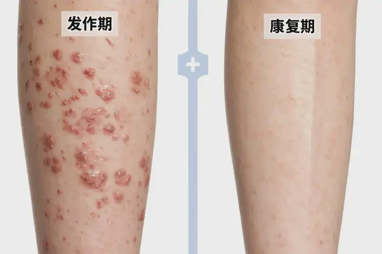 女生小腿出濕疹能夠徹底治愈嗎(圖2)