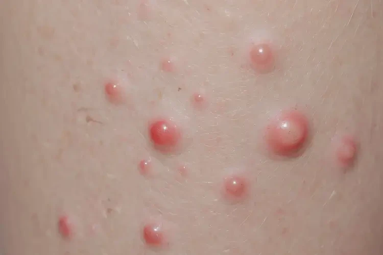 小儿大腿经常起湿疹不管它会自己自愈吗(图4)