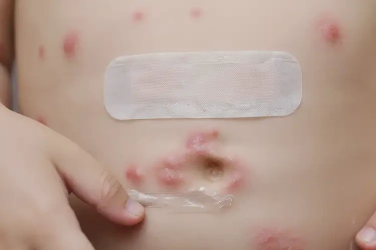 小兒肚子出濕疹不管它會自己好嗎(圖3)