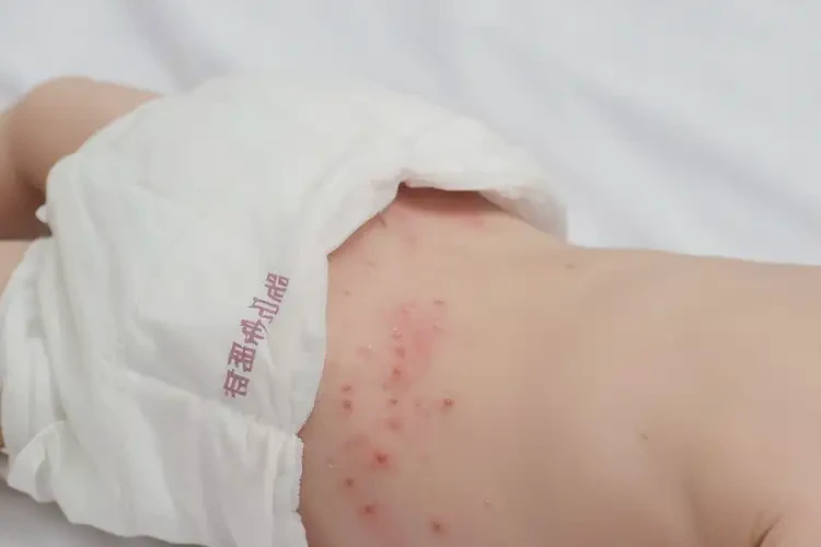 新生儿屁股经常起湿疹可不可以彻底自愈(图2)