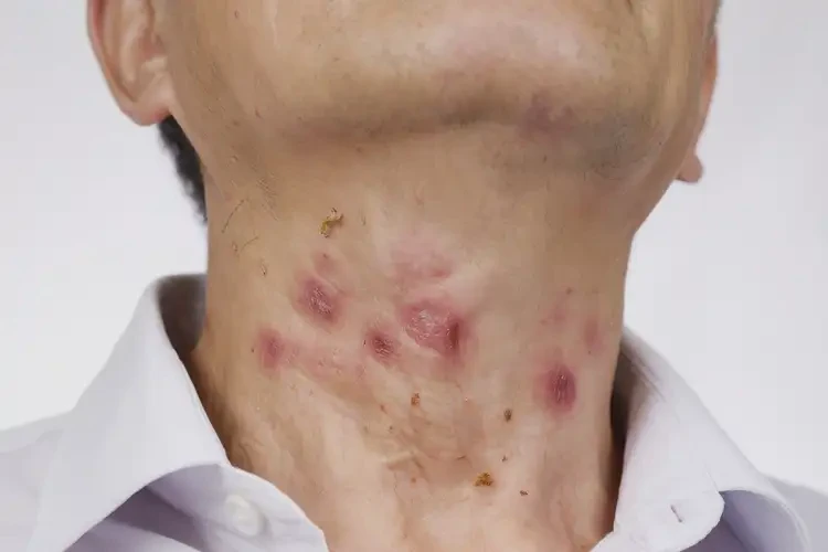 男人脖子出濕疹不管它會自己痊愈嗎(圖4)