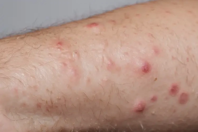 青少年手臂上偶爾長濕疹可不可以徹底自愈(圖4)