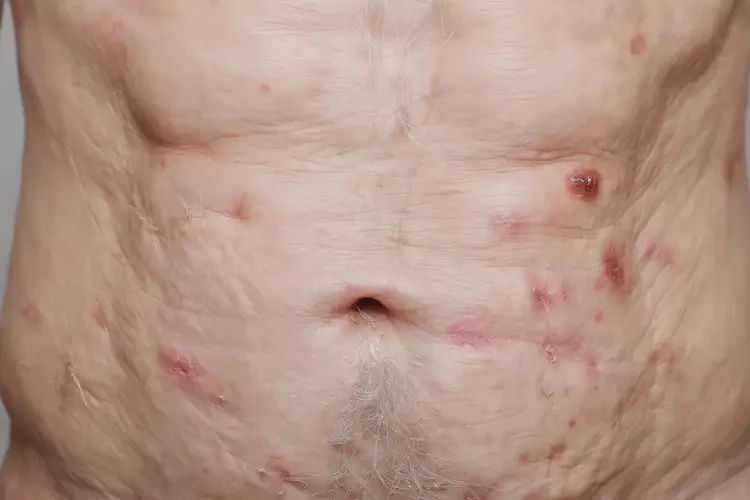 高齡老人肚子出現(xiàn)濕疹能不能徹底自愈(圖4)