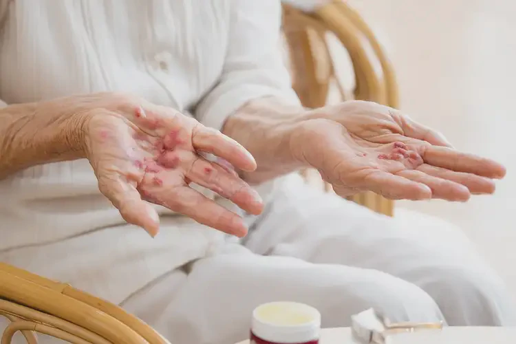 高齡老人手上長濕疹能夠徹底治愈嗎(圖4)