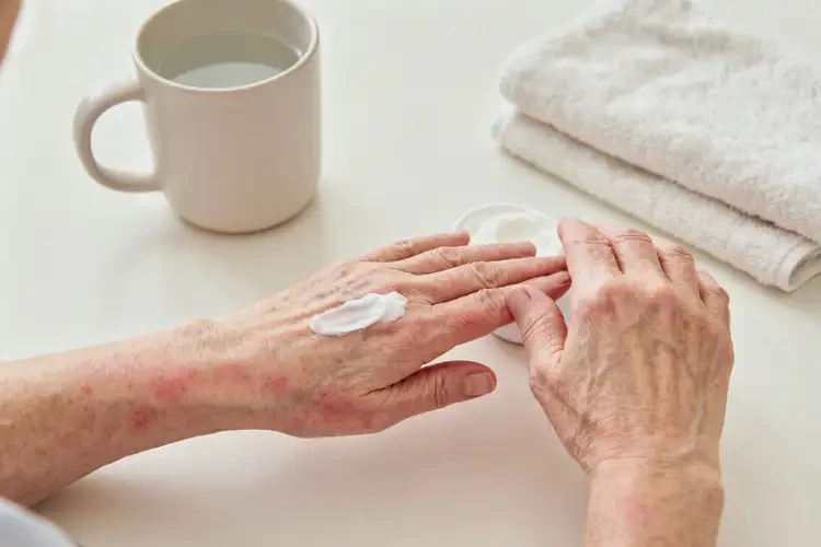 老人手上容易長濕疹能靠自己自愈嗎(圖3)