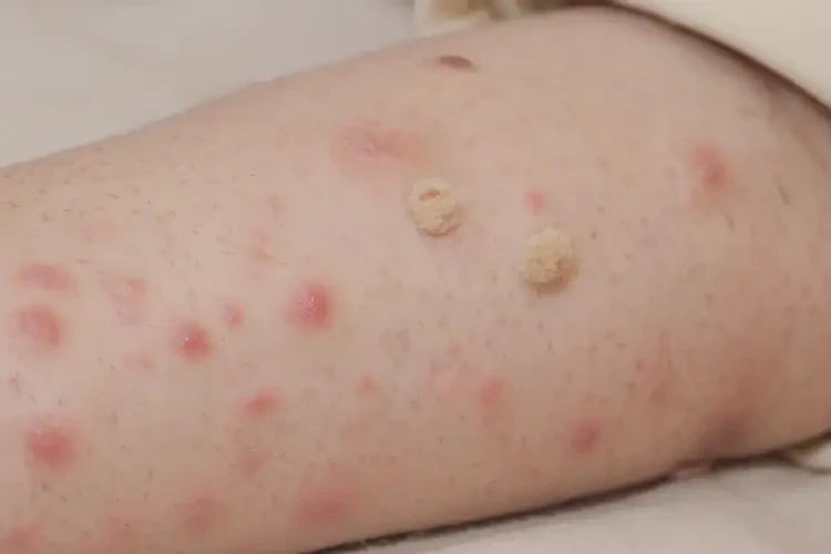 兒童屁股上偶爾起濕疹能徹底自愈嗎(圖2)