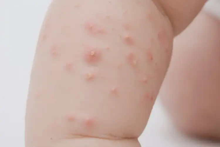 少兒屁股上偶爾起濕疹可不可以徹底自愈(圖2)