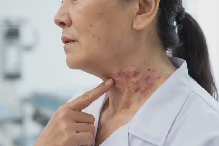 女性脖子偶爾長(zhǎng)濕疹可以徹底自愈嗎(圖4)