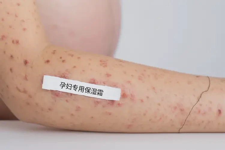 孕婦手臂上容易長濕疹能靠自己自愈嗎(圖4)