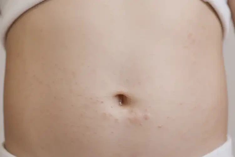 小学生肚子容易起湿疹能够彻底治愈吗(图4)