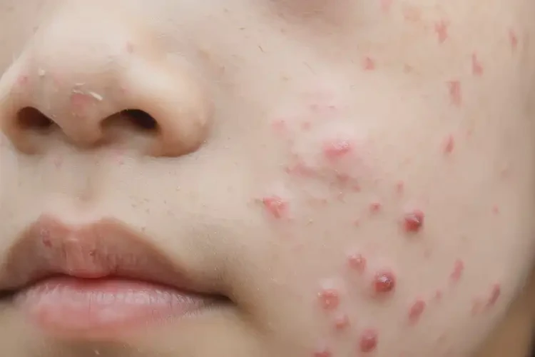 中學(xué)生臉上長(zhǎng)濕疹可不可以徹底自愈(圖4)