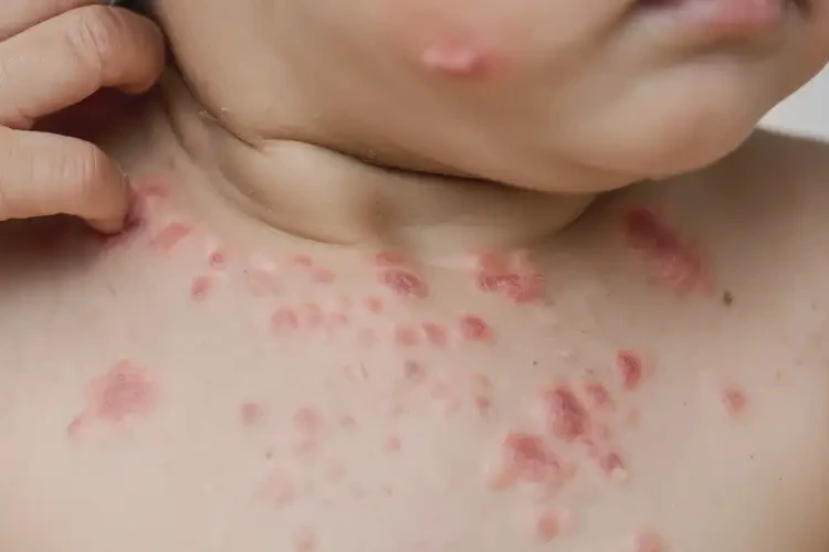 兒童脖子經(jīng)常長濕疹能靠自己自愈嗎(圖4)