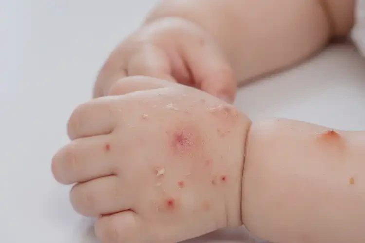 幼兒身上經(jīng)常長濕疹不管它會(huì)自己自愈嗎(圖4)