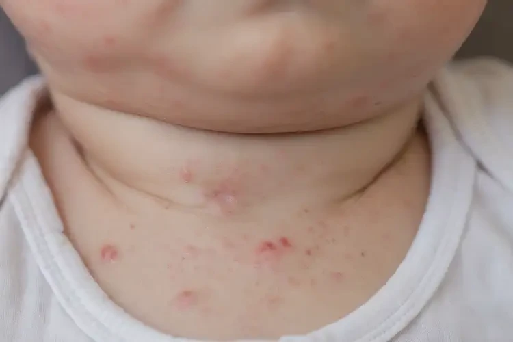 幼兒脖子上出濕疹能不能徹底自愈(圖4)