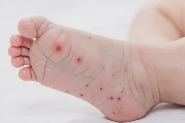 嬰幼兒腳上長濕疹能靠自己自愈嗎(圖4)