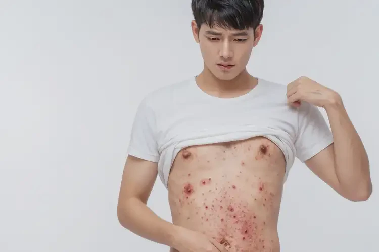 青年人肚子上有濕疹不管它會自己自愈嗎(圖4)