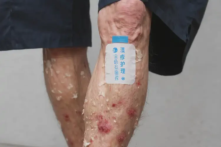 老年人小腿上出湿疹能不能彻底自愈(图4)