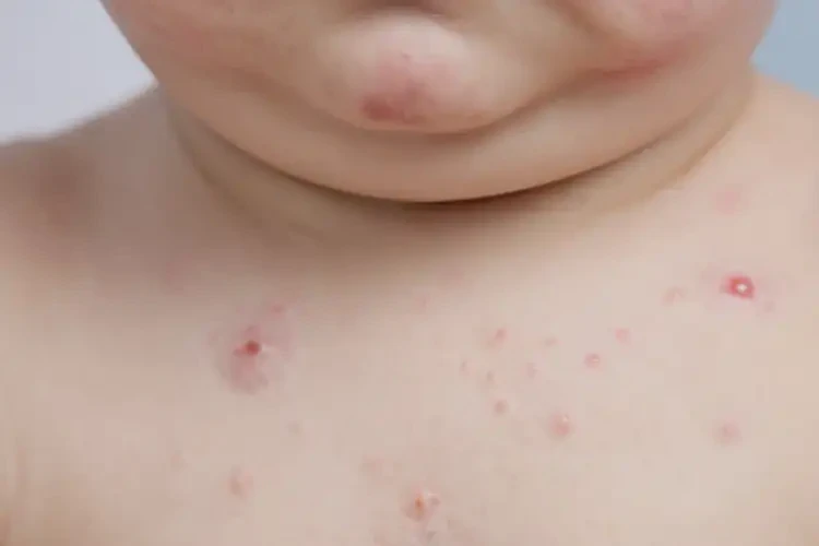 婴幼儿脖子出湿疹可以彻底自愈吗(图4)