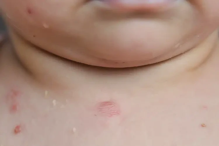 兒童脖子偶爾長濕疹不管它會自己自愈嗎(圖4)