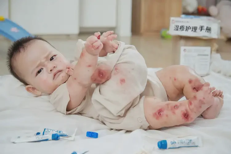 寶寶四肢容易長濕疹不管它會自己自愈嗎(圖4)