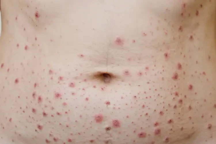 女生肚子長濕疹能徹底自愈嗎(圖4)