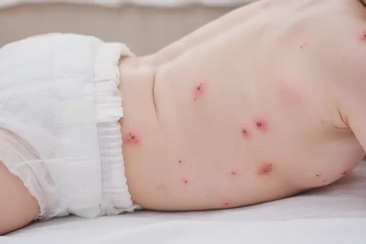 嬰兒屁股上出現濕疹不管它會自己自愈嗎(圖3)