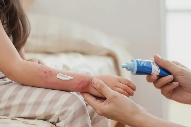 孩子手上容易起湿疹不管它会自己自愈吗(图2)