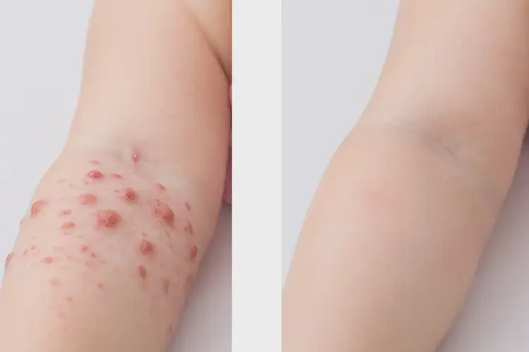 幼兒大腿上偶爾起濕疹能靠自己自愈嗎(圖2)