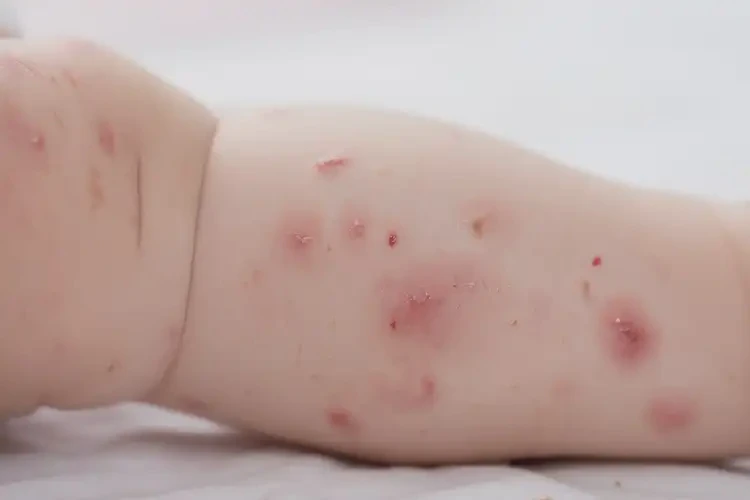 嬰幼兒小腿容易起濕疹能徹底自愈嗎(圖4)