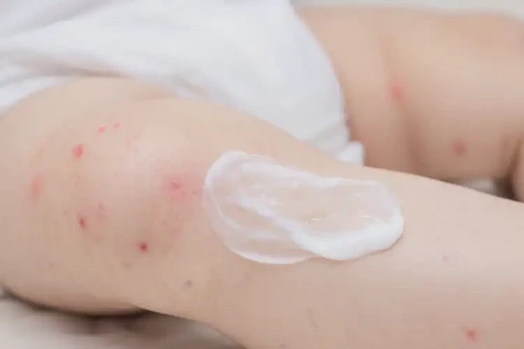 寶寶小腿出現(xiàn)濕疹能徹底自愈嗎(圖4)