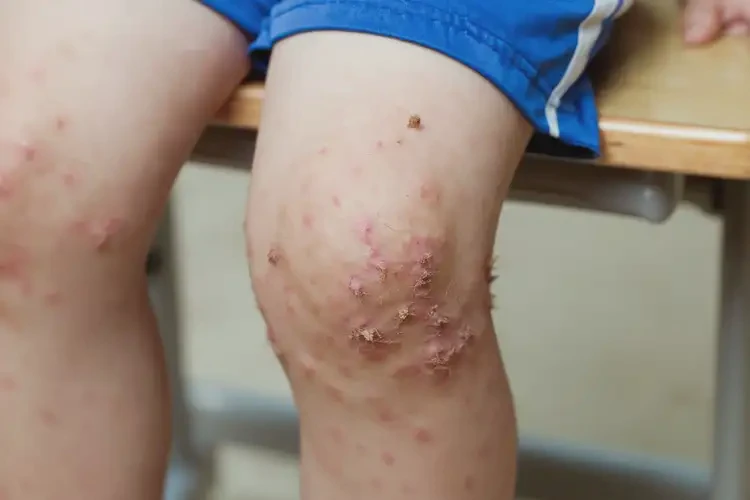 小學(xué)生小腿容易起濕疹能不能徹底自愈(圖4)