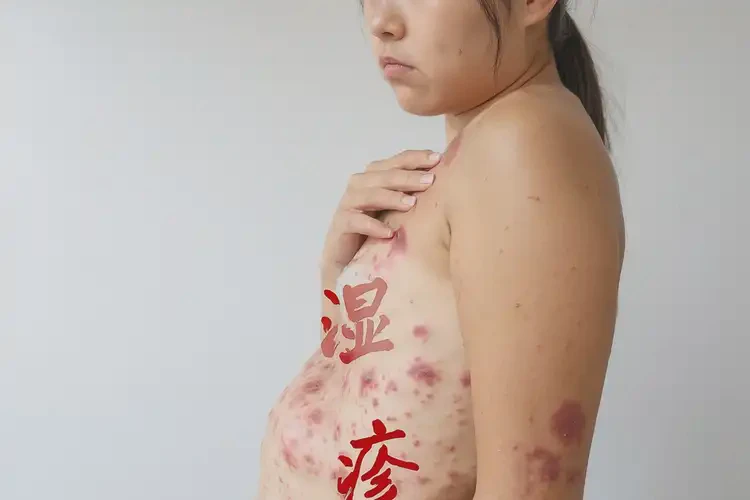 女人肚子上容易起濕疹不管它會自己好嗎(圖4)
