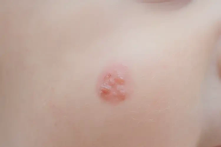 小孩屁股上容易長濕疹能徹底自愈嗎(圖4)